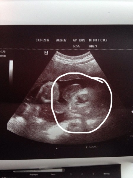 18 недель мальчик. УЗИ 19 недель беременности мальчик. Девочка на УЗИ.